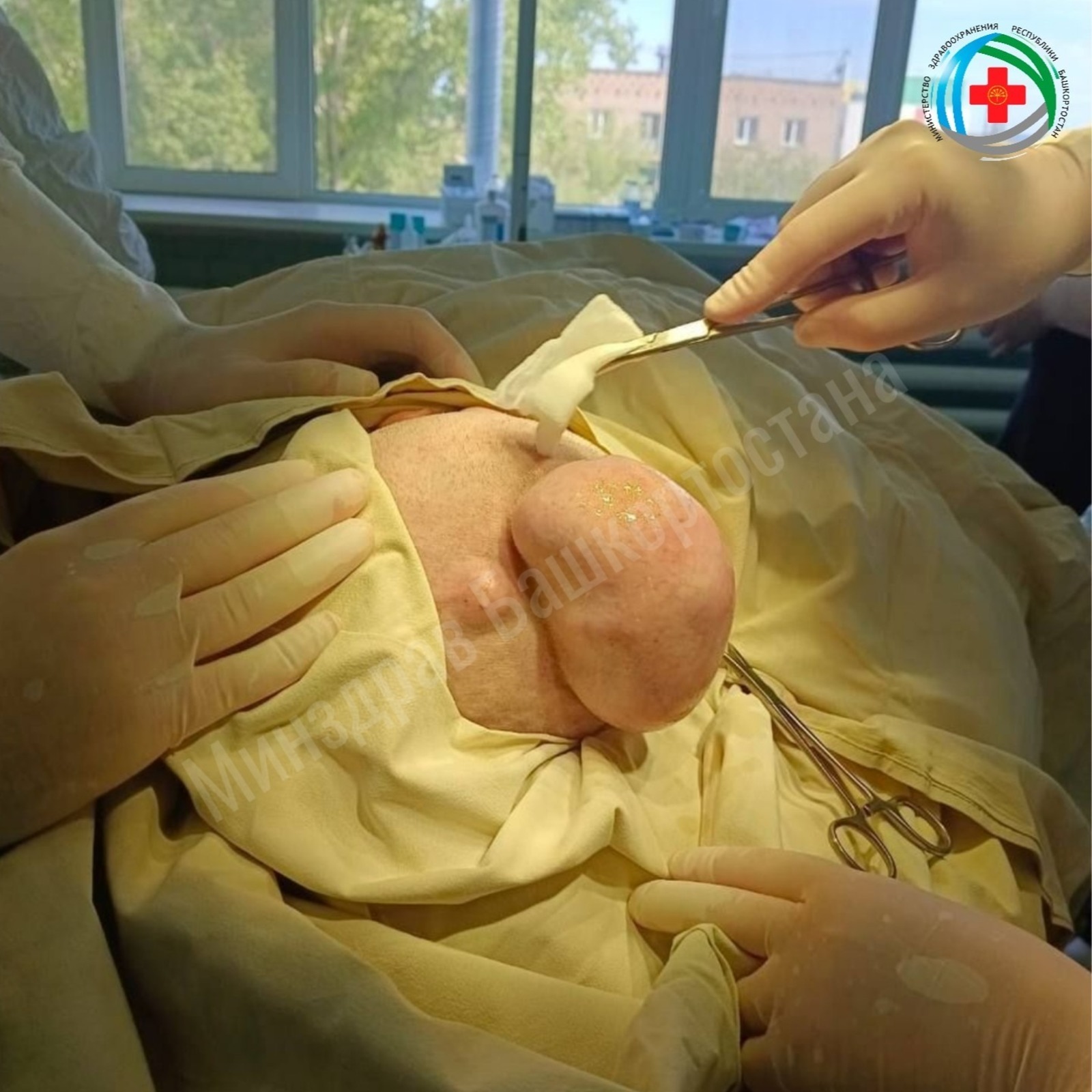 В Башкирии врачи удалили у пациентки огромную кисту на голове